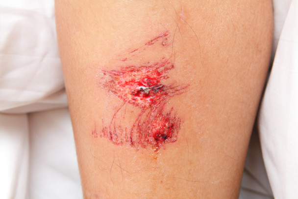 Wound on leg - Photo, Image