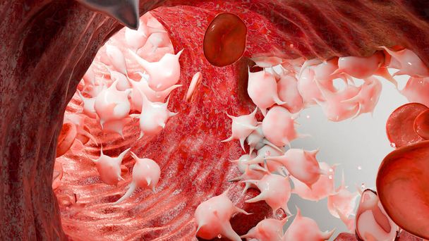 Hämostase. Rote Blutkörperchen und Blutplättchen in den Blutgefäßen, Gefäßverengung, Wundheilung. Blutgerinnsel Embolien, Hämophilie. Fibrinolyse, Verletzung Blutung Gerinnung, 3D-Render - Foto, Bild
