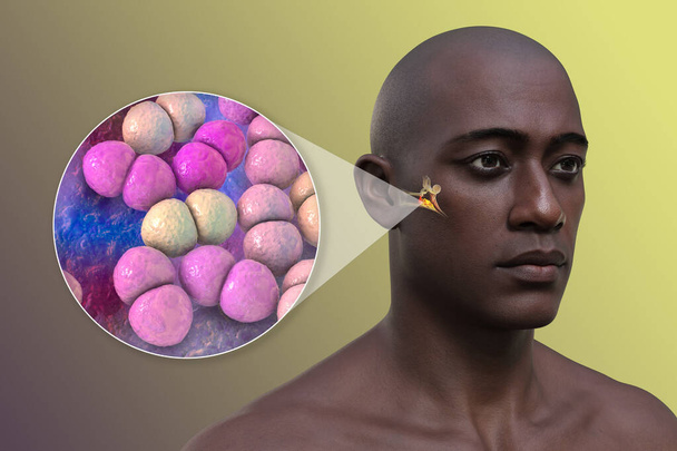 Otitis media infección del oído en un hombre, y vista de cerca de las bacterias Streptococcus pneumoniae, los agentes etiológicos comunes de la inflamación del oído medio, ilustración 3D. - Foto, imagen