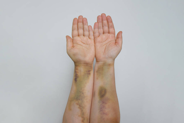 Main féminine avec peau meurtrie. Bras avec ecchymose près sur fond gris - Photo, image