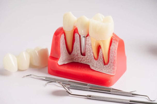 Implant stomatologiczny, sztuczne korzenie zębów w szczękę, kanał korzeniowy leczenia stomatologicznego, choroba dziąseł, model zębów dla stomatologa studiującego stomatologię. - Zdjęcie, obraz