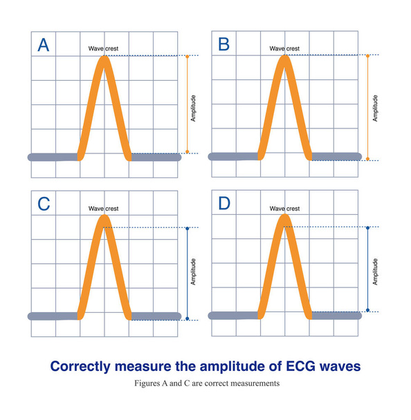 A medição correta da amplitude do ECG deve ser da borda superior da linha de base até o pico ou a borda inferior da linha de base até o vale.. - Foto, Imagem