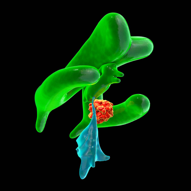 Una ilustración científica en 3D que representa el agrandamiento de los ventrículos laterales y terceros del cerebro (hidrocefalia, indicada en verde), causada por un tumor cerebral que comprime el acueducto cerebral (en rojo). - Foto, imagen