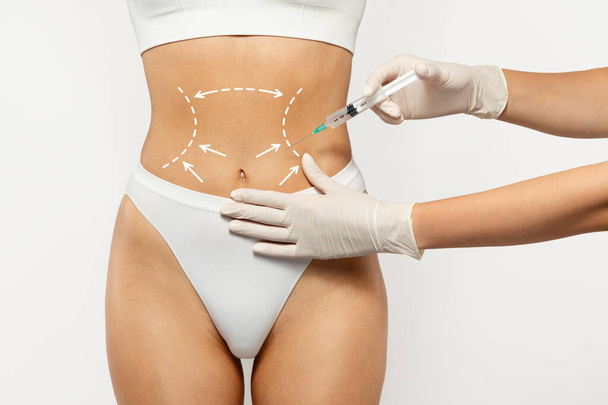 Europäische Millennial Dame in weißer Unterwäsche erhält kosmetische Eingriffe mit markierten Stellen auf dem Rücken, während die behandschuhte Hand des Arztes Behandlung injiziert. Kosmetische Chirurgie und Körperkonturierung, Fettabsaugung - Foto, Bild