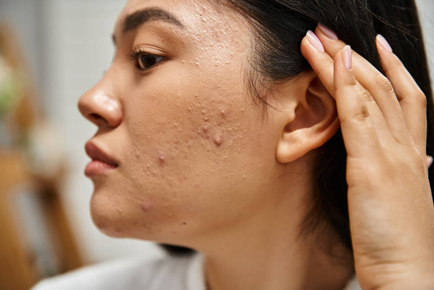 Konzept zur Hautpflege, Nahaufnahme einer jungen Asiatin mit brünetten Haaren und Akne im Gesicht - Foto, Bild