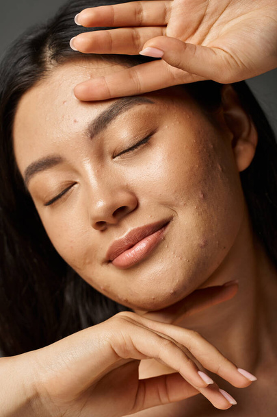 potěšená mladá asijská žena s akné náchylné kůže a zavřené oči na šedém pozadí, kožní problémy - Fotografie, Obrázek