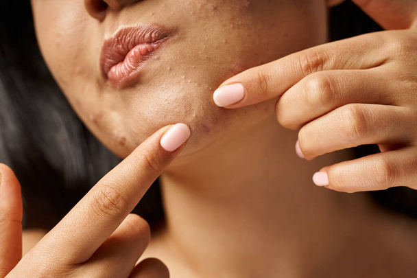 close-up foto van bijgesneden jonge vrouw met acne gevoelige huid popping puistje op gezicht, huidproblemen - Foto, afbeelding