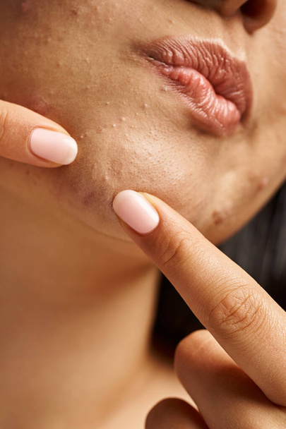close-up foto van bijgesneden jonge vrouw met acne gevoelige huid popping pukkel op gezicht, verticaal schot - Foto, afbeelding