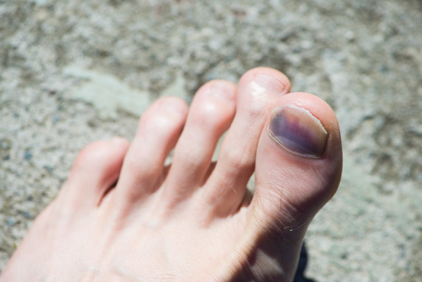 Pied caucasien avec gros orteil bleu et ongle après accident
 - Photo, image