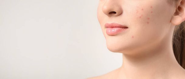 Jonge vrouw met acne probleem op lichte achtergrond met ruimte voor tekst, close-up - Foto, afbeelding