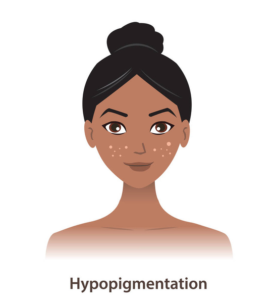 Hipopigmentacja i białe plamy na wektorze twarzy kobiety izolowane na białym tle. Zabarwienie skóry, rozjaśniony barwnik, mała ilość melaniny w skórze. Koncepcja zaburzeń pigmentu skóry. - Wektor, obraz