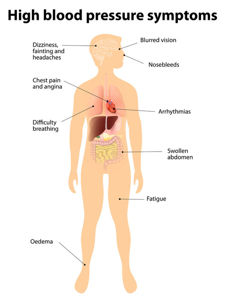 Symptômes de l'hypertension. hypertension artérielle
 - Vecteur, image
