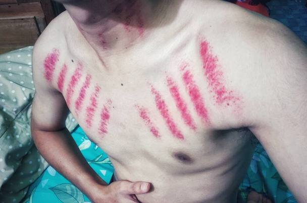 Κόκκινα σημάδια από γρατζουνιές στο στήθος ενός άντρα. Kerokan είναι μια παραδοσιακή μέθοδο θεραπείας της Ιάβας για τη θεραπεία των συμπτωμάτων του κρυολογήματος. Αυτή η μέθοδος θεραπείας είναι αρκετά δημοφιλής στην Ινδονησία - Φωτογραφία, εικόνα