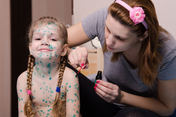 Mom misses the little girl with chickenpox sores zelenkoj - Foto, immagini