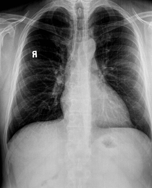 Chest xray of of patient with emphysematous lungs, hilar  adenopathy showing heart, vertebrae and pulmonary vessels - Photo, Image