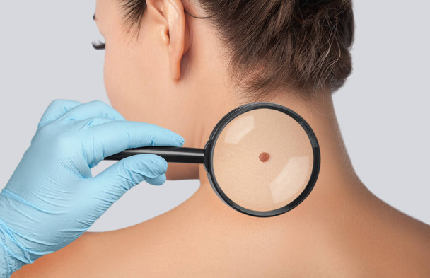 The doctor examines a large mole on the shoulder with a magnifying glass in the clinic. Cosmetology treatment of problem skin on the face and body. - Photo, Image