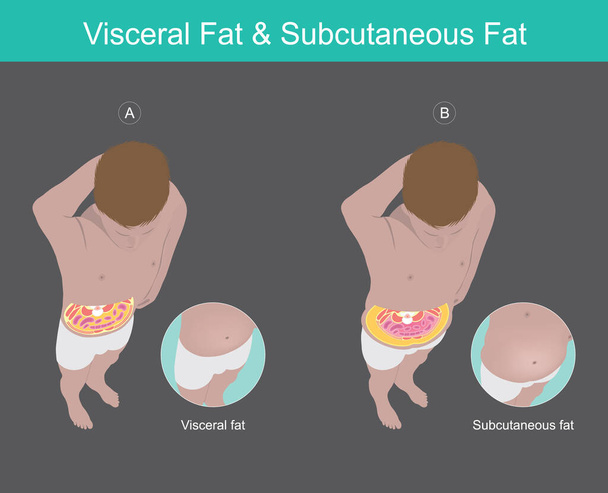 Ilustração conhecimento da gordura visceral do abdômen em humanos - Vetor, Imagem