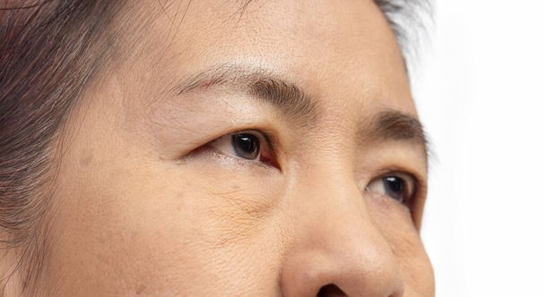 De ptosis of hangende oogleden bij Aziatische senior vrouw. - Foto, afbeelding