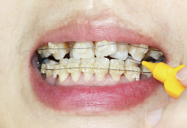 Zblízka křivé zuby s rovnátkama, mezizubní čištění - Fotografie, Obrázek