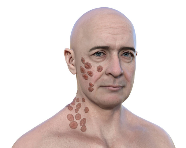 3D-kuva, joka kuvaa miestä, jolla on useita kasvojen ja kaulan vaurioita, joissa on Blastomyces dermatitidis sienen aiheuttama ihon blastomykoosi. - Valokuva, kuva