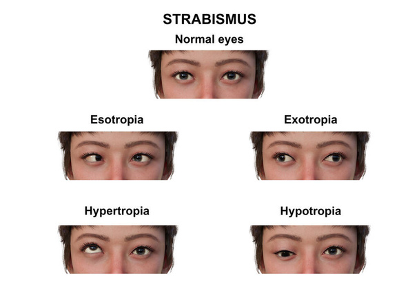 Ilustração em 3D anotada de uma mulher com vários estrabismos: esotropia, exotropia, hipertropia e hipotropia. - Foto, Imagem