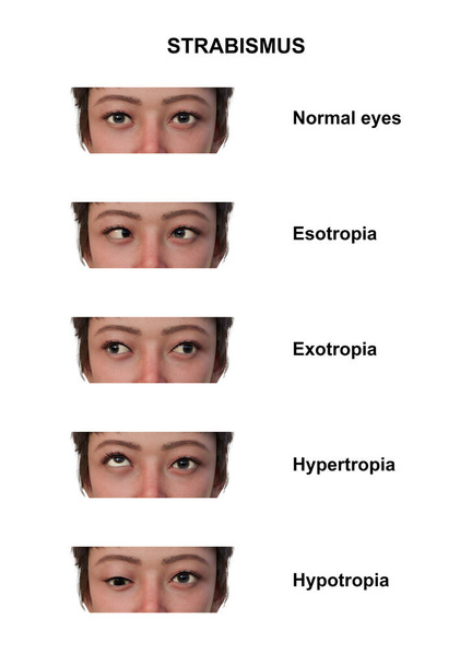 Geannoteerde 3D illustratie van een vrouw met verschillende soorten strabismus: esotropie, exotropie, hypertropie en hypotropie. - Foto, afbeelding