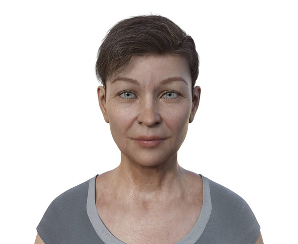Een vrouw met ptosis, 3D illustratie weergeven - Foto, afbeelding
