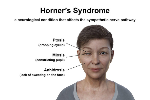 Ilustración científica en 3D con una mujer con síndrome de Horner, que representa la ptosis, miosis y anhidrosis debido a la interrupción del nervio simpático. - Foto, imagen