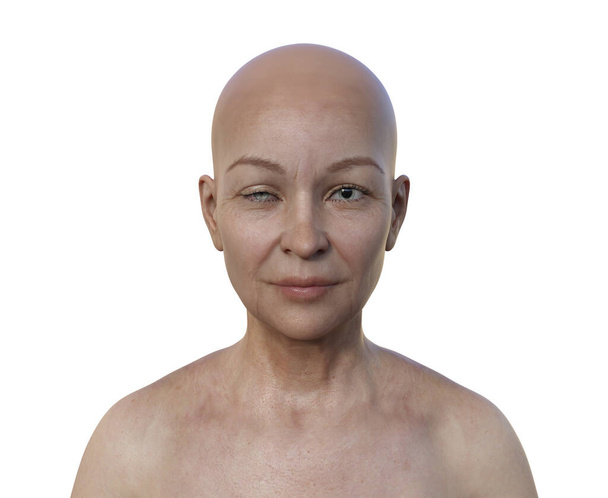 Научная 3D иллюстрация с участием женщины с синдромом Хорнера, изображающая птоз и миоз из-за нарушения симпатического нерва. - Фото, изображение