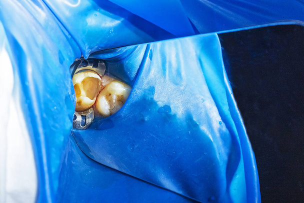 ból zęba pacjenta z otworami przed wypełnieniem - Zdjęcie, obraz