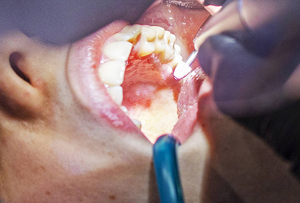 chica en una cita con el dentista con la boca abierta. Tratamiento ortodoncista y cuidado dental - Foto, Imagen