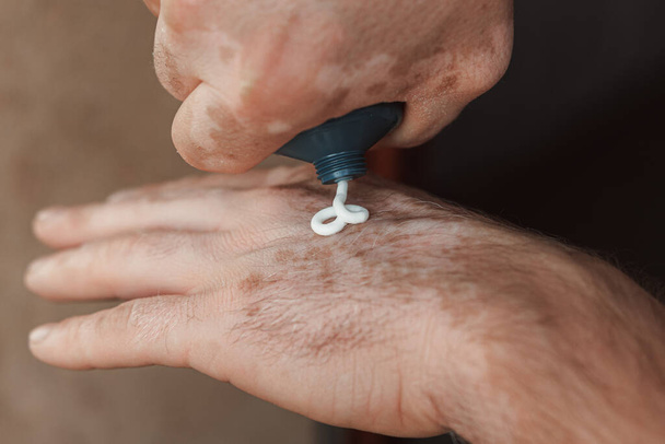 Mains masculines avec Vitiligo Care en utilisant la crème comme un traitement pour les problèmes de peau saisonniers. - Photo, image