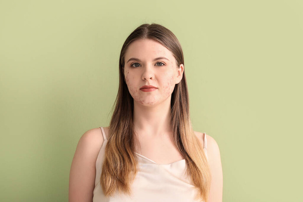 Jeune femme avec problème d'acné sur fond vert, gros plan - Photo, image