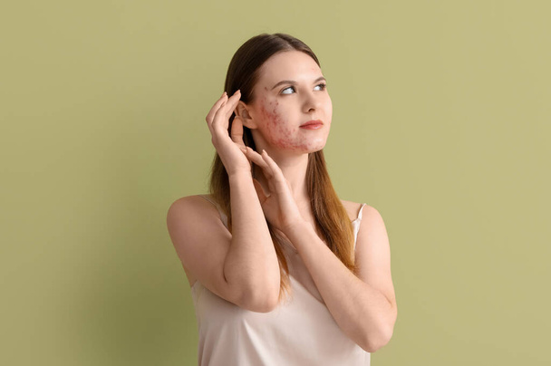 Young woman with acne problem on green background - Photo, Image