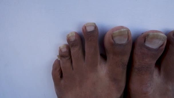 2022. október 14. Uttarakhand, India. Elhanyagolt lábkörmök egy nem higiénikus lábviszonyokkal rendelkező indiai felnőttnél. Az önellátás és a személyes higiénia fogalma. - Felvétel, videó