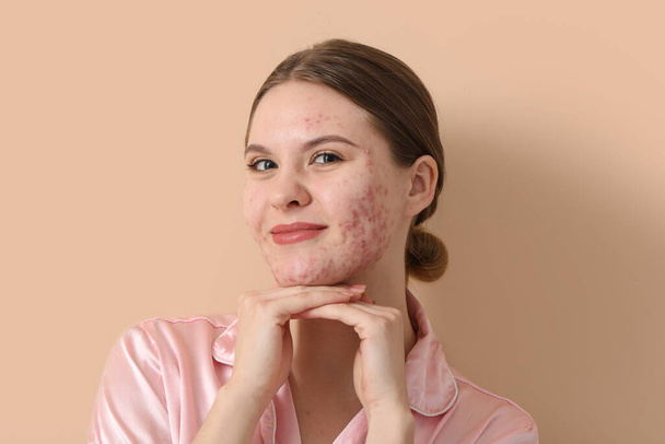 Young woman with acne problem on beige background, closeup - Photo, Image