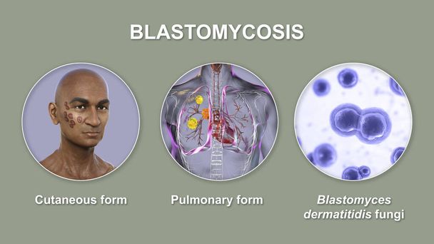Forme cliniche di blastomicosi. Blastomicosi cutanea e polmonare e visione ravvicinata dei funghi Blastomyces dermatitidis, illustrazione 3D. - Foto, immagini