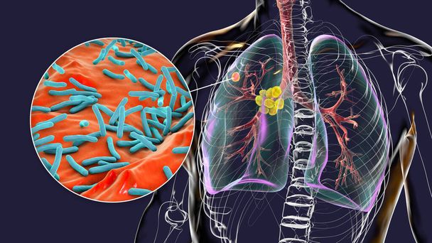 Tuberculose pulmonar primária, ilustração 3D com complexo de Ghon e linfadenite mediastinal, juntamente com visão de perto das bactérias Mycobacterium tuberculosis. - Foto, Imagem