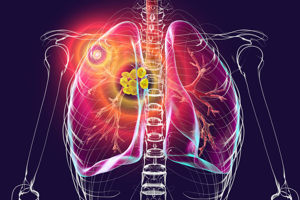 プライマリ肺結核,3Dイラスト ゴンホン複合体と中性リンパ腫をフィーチャー. - 写真・画像