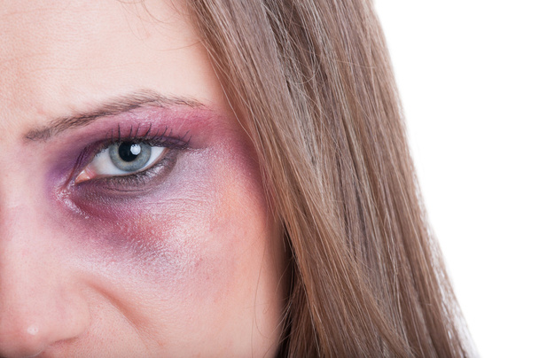 Μαύρο ή μάτι μελανιασμένο γυναίκα - Φωτογραφία, εικόνα