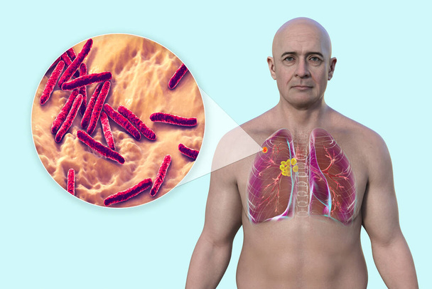 男性の肺結核. グノン複合体および中性リンパ炎を有する肺を示す3Dイラストと,マイコバクテリア結核細菌のクローズアップビュー. - 写真・画像