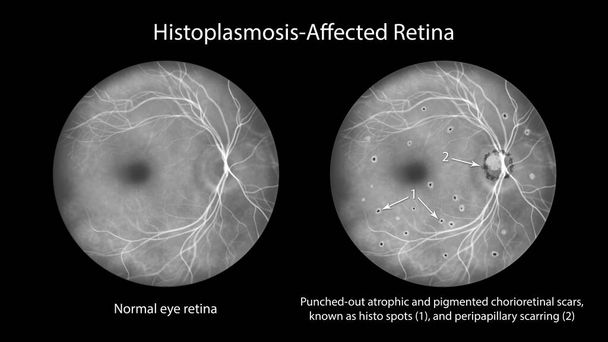 Retina feltételezett occularis Histoplasmosis szindrómában, ahogy a fluoreszcein angiográfiában látható, az illusztráció kiütéses atrófiás és pigmentált chorioretinalis hegeket (histo foltokat) és peripapilláris hegesedést mutat - Fotó, kép