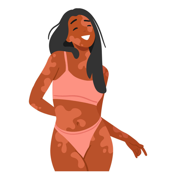 Confident, Happy Woman With Vitiligo Embraces Her Unique Beauty, Radiating Joy In A Stylish Bikini. Female Character Challenging Conventional Standards And Celebrating Diversity With Pride - Vector, Image