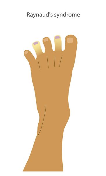 Un piede con i sintomi della sindrome di Raynauds sulla punta delle dita dei piedi. Cianosi periferica mostrata come dita bianche e scolorite. . Illustrazione vettoriale - Vettoriali, immagini