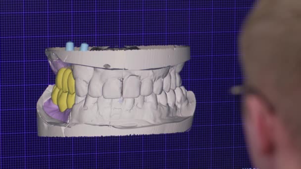 Programa em monitor de computador usado pelo técnico odontológico para fazer restauração protética para os dentes. Programa Projetando dentes protéticos para tratamento. - Filmagem, Vídeo