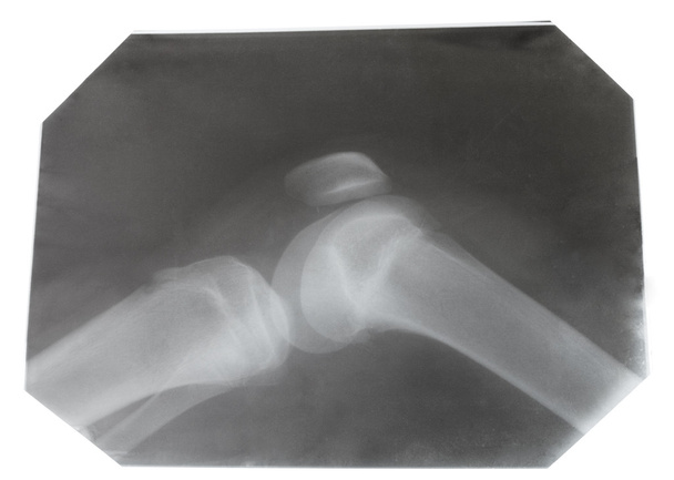 Image radiographique de l'articulation du genou humain
 - Photo, image