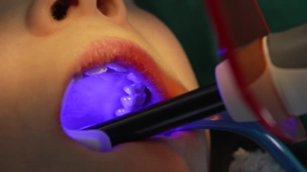 Οδοντίατρος Χρησιμοποιώντας Photopolymerizer στα δόντια του παιδιού, Close-up Οδοντιατρική φροντίδα - Πλάνα, βίντεο