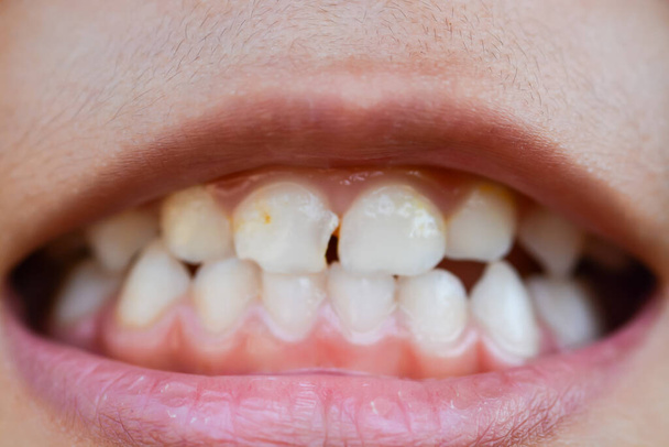 Ein vergrößertes Bild fängt die Münder von Kindern mit falsch ausgerichteten, gebrochenen Zähnen und Odontolith ein. - Foto, Bild
