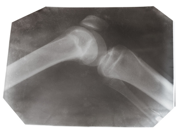 Fotografia de raios-X da articulação do joelho humano isolada
 - Foto, Imagem