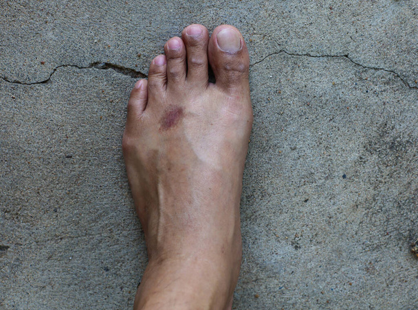 pé esquerdo do homem é condição de dor, pé seco - Foto, Imagem